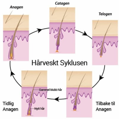 Permanent hårfjerning med blendmetoden